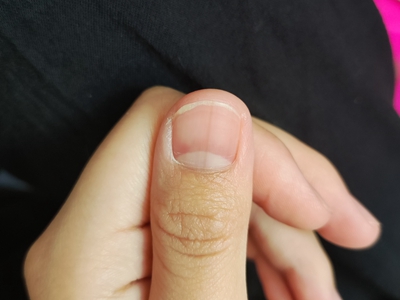 甲母痣手指甲上有浅褐色竖纹图.jpeg