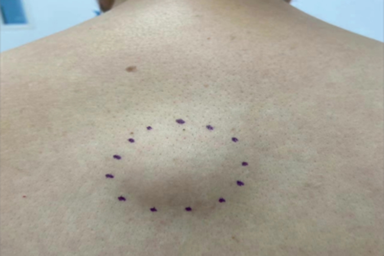 Ⅲ型痛性肥胖病症状图 Ⅲ型痛性肥胖病症状图