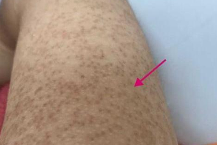 手臂毛周角化症图