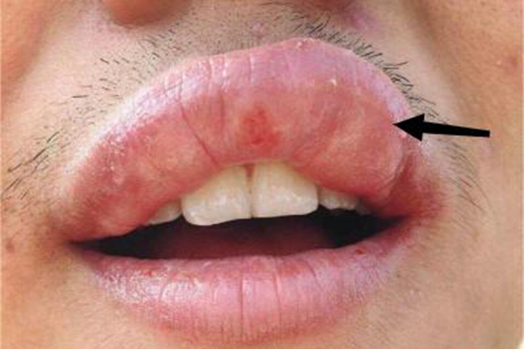 海鲜过敏嘴唇红肿图