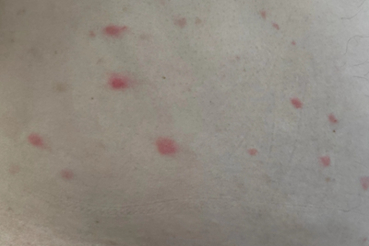 丘疹性荨麻疹腹部红点图