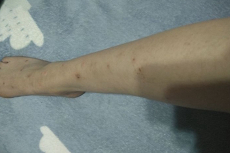 跳蚤叮咬小腿斑图