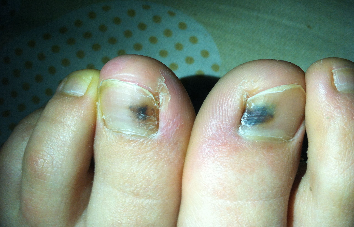 灰指甲大脚趾边缘一侧发黑图 灰指甲大脚趾边缘一侧发黑图