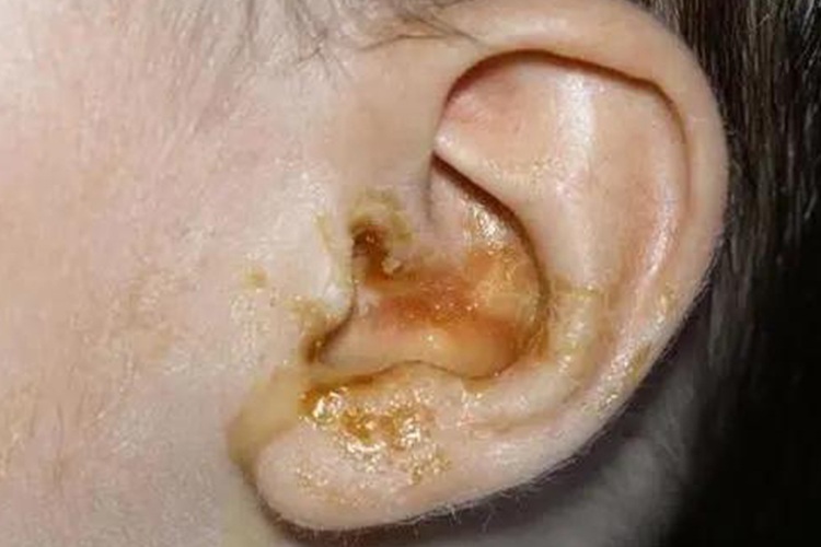 外耳长癣图片图片