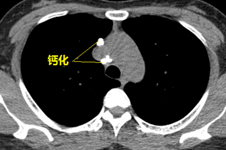 肺部钙化灶图