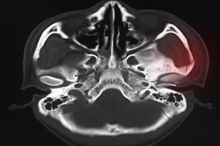 颧骨骨折影像图