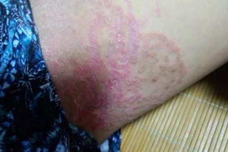 股癣大腿根内侧红斑起皮图