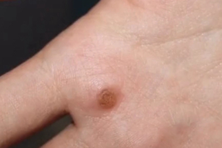 扁平疣样职业性疣赘手部疙瘩图