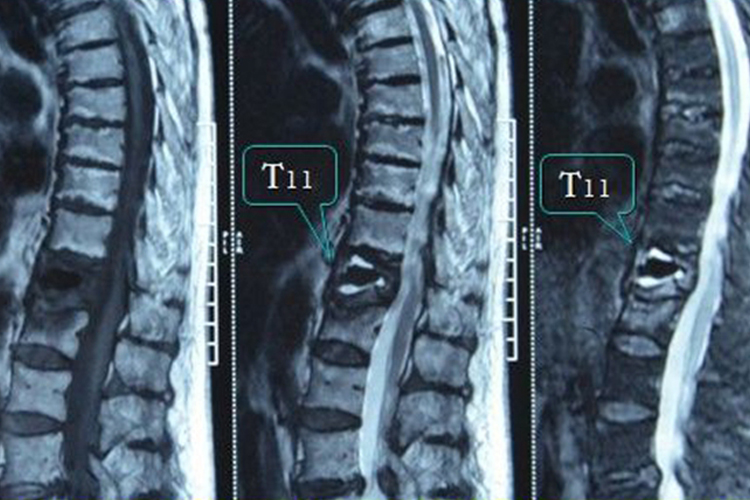 胸椎第11-12节骨折影像图 胸椎第11-12节骨折影像图