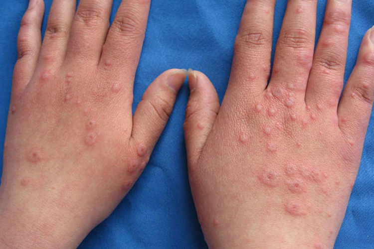 多形红斑红疹图