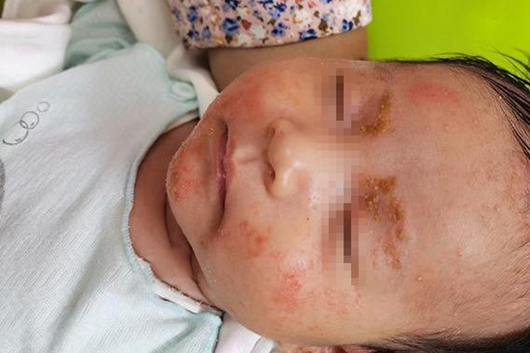 婴儿湿疹图 婴儿湿疹图