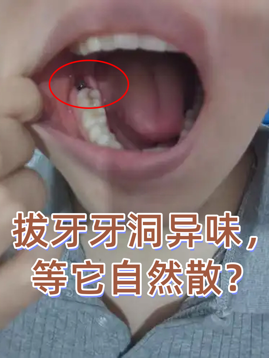 拔牙牙洞异味，等它自然散？