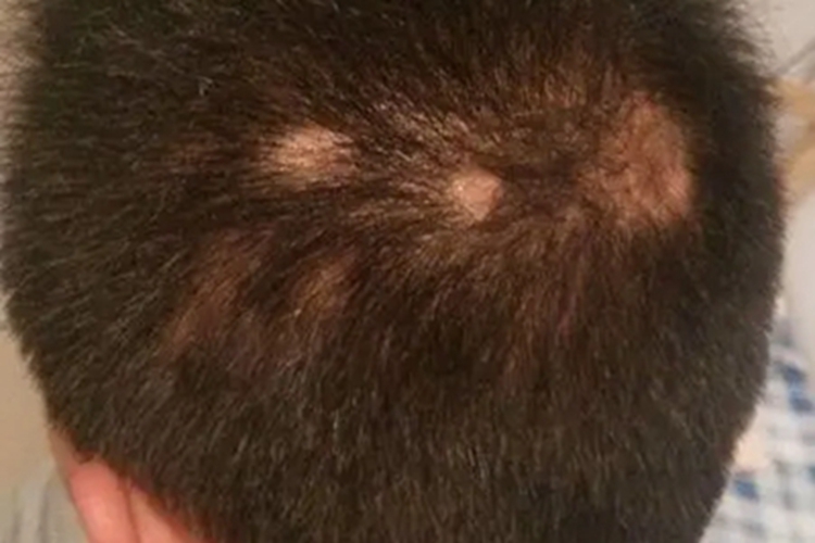 梅毒性脱发头皮上有圆形白斑图