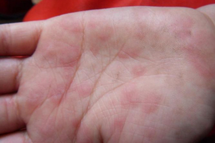 鹦鹉热手掌有红斑图