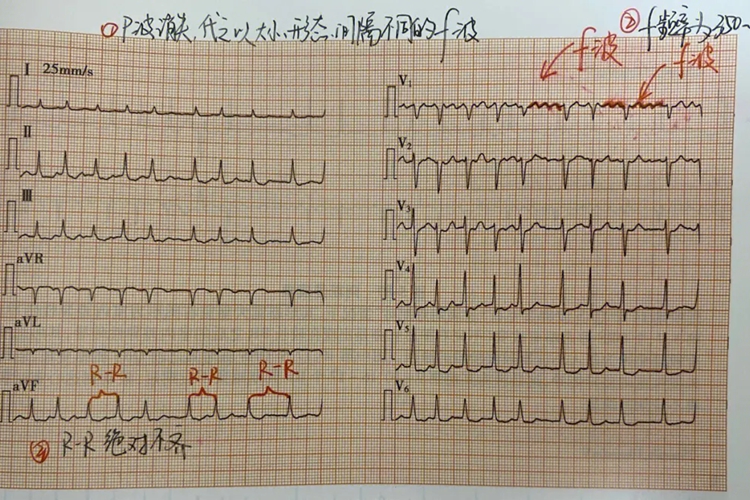 心房颤动心电图