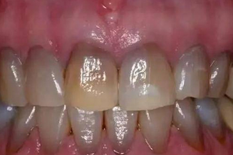 重度四环素牙牙根发黑图