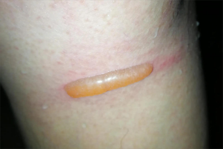 摩擦水疱腿水疱图