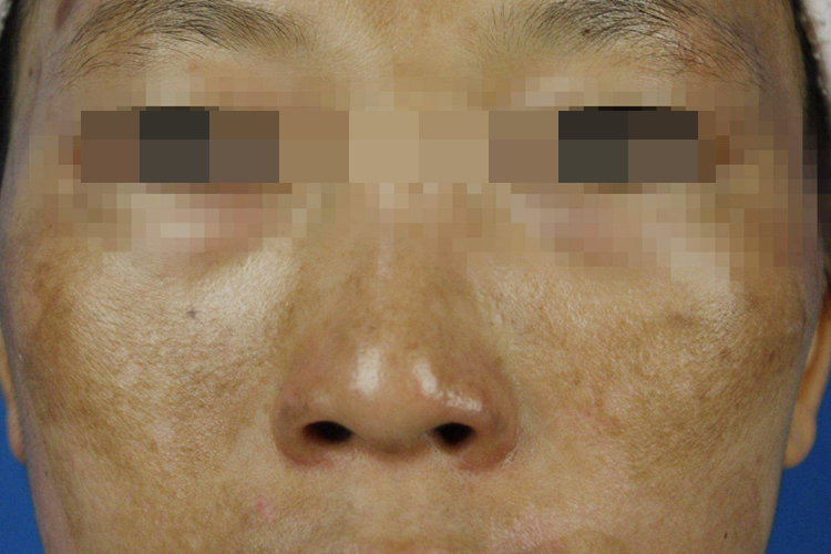 脸上长大块黄褐斑图