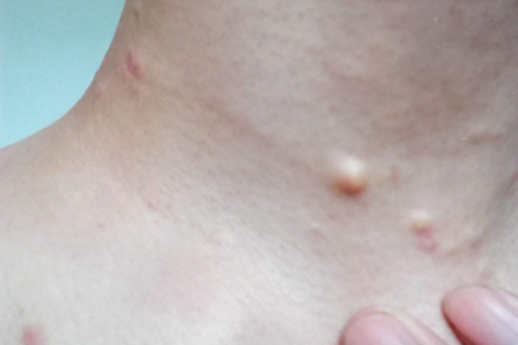 网状组织细胞肉芽肿症状图 网状组织细胞肉芽肿症状图