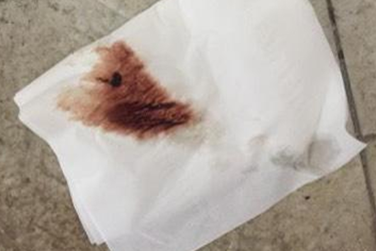 输卵管妊娠阴道流血初期图 输卵管妊娠阴道流血初期图