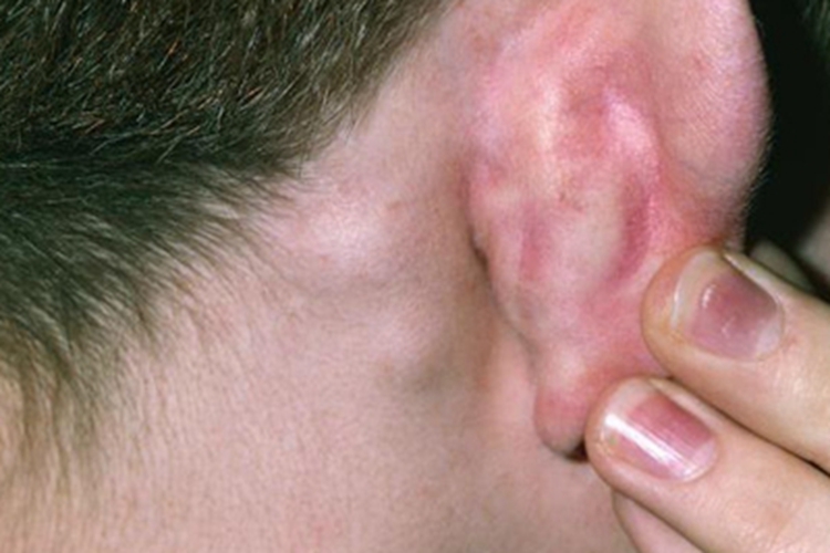 艾滋病急性感染期耳后肿大图 艾滋病急性感染期耳后肿大图