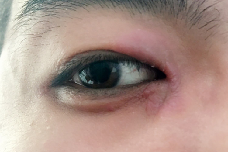 眼睑皮炎症状图片图片