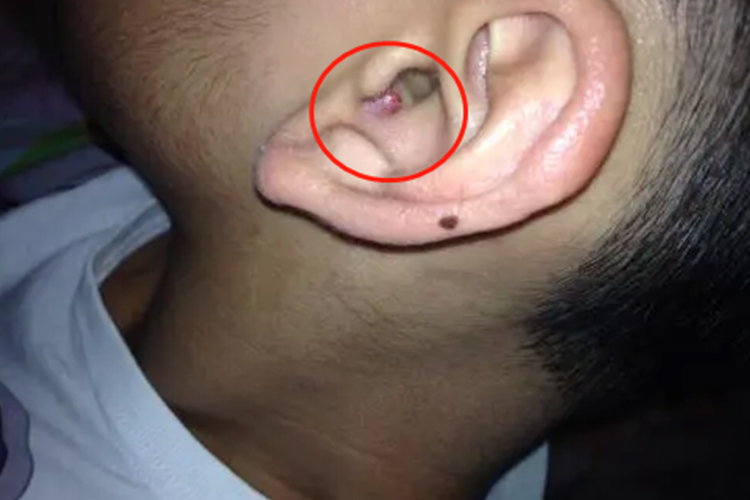 小孩外耳道疖肿图