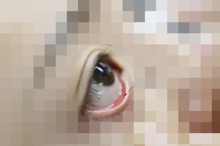 眼睛结膜囊位置图 眼睛结膜囊位置图