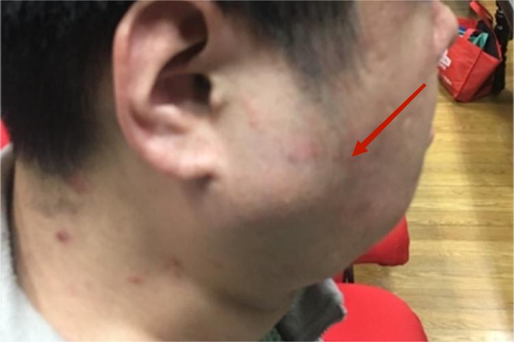 静脉畸形耳前症状图 静脉畸形耳前症状图