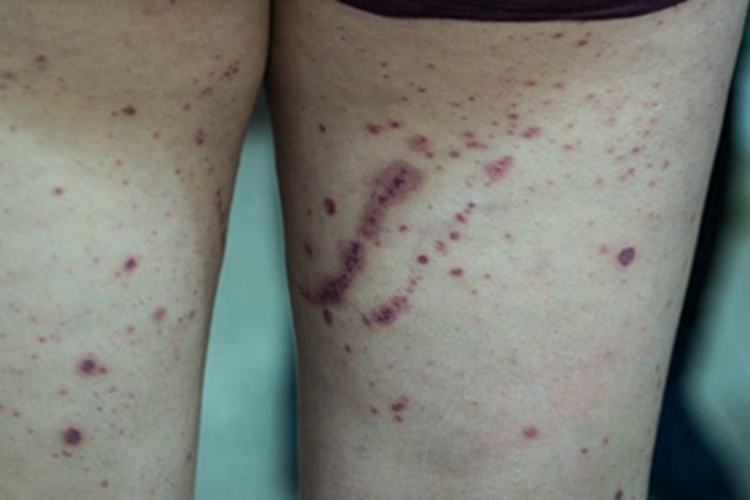 过敏性紫癜大腿血点图