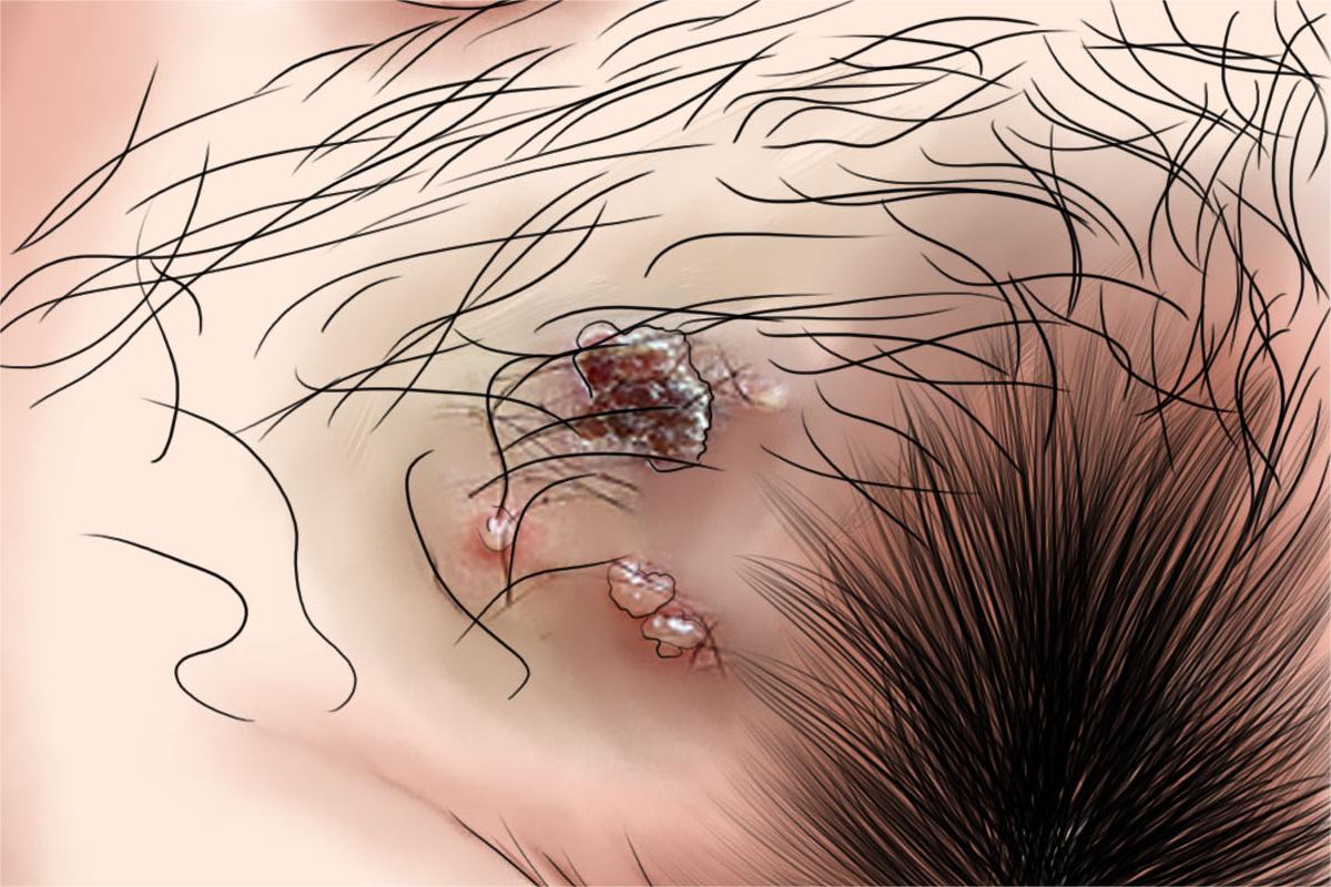 女性生殖器疱疹结痂图