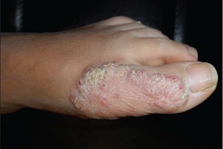 皮肤非典型分枝杆菌病脚部症状图