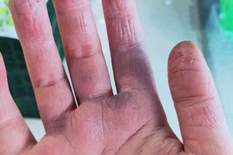 冻疮样红斑狼疮手指裂纹图 冻疮样红斑狼疮手指裂纹图