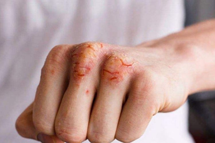 皲裂性湿疹手背脱皮图 皲裂性湿疹手背脱皮图