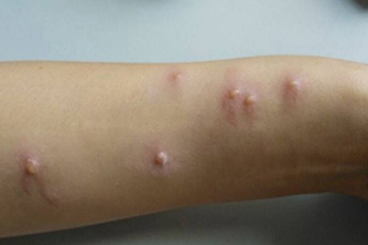 蠓叮咬小水疱图