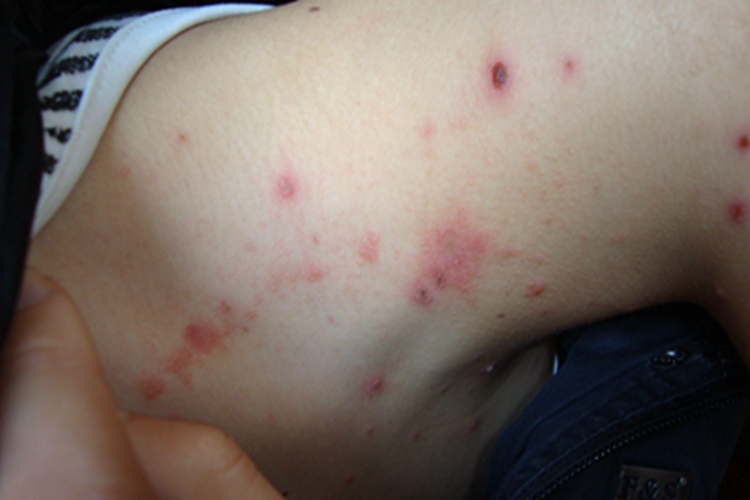 水痘脖子上长水疱干瘪结痂图 水痘脖子上长水疱干瘪结痂图