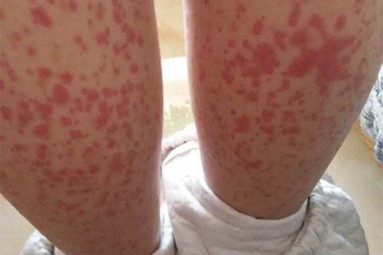 过敏性紫癜小腿起了一堆小红点图