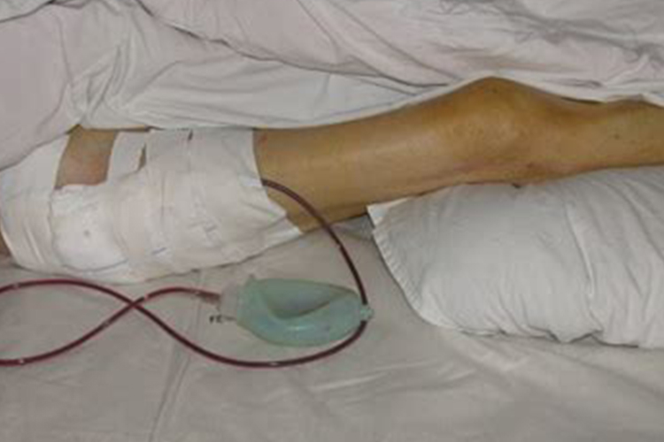 股骨头置换后正确睡姿图