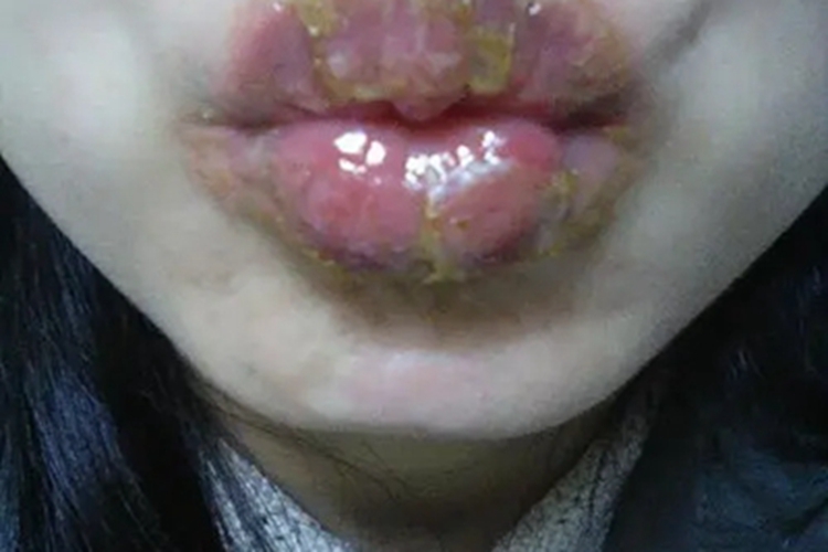 慢性唇炎嘴唇渗液结黄痂图