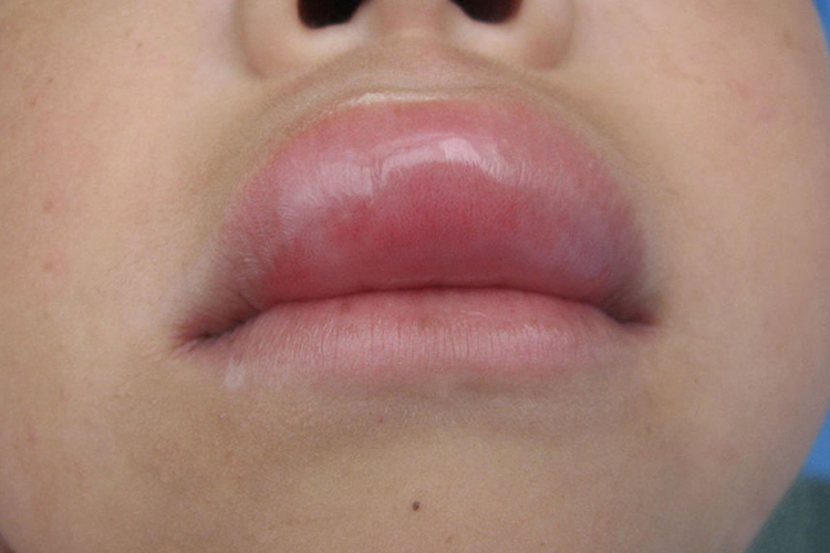 吃鱼腥草过敏血管神经性水肿图