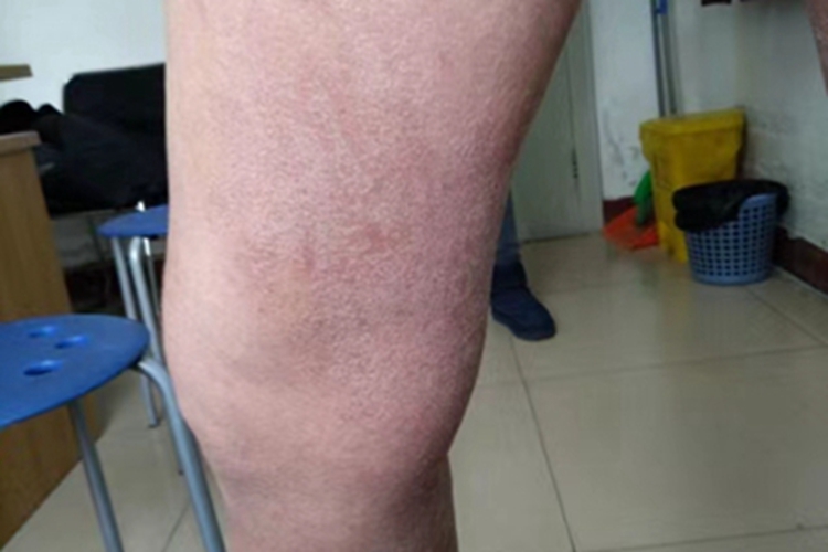 干性湿疹腿上泛红有碎屑图 干性湿疹腿上泛红有碎屑图