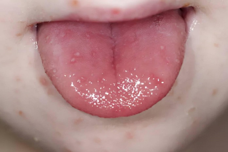 手足口病舌尖症状图