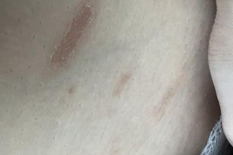 体癣腹部斑图 体癣腹部斑图