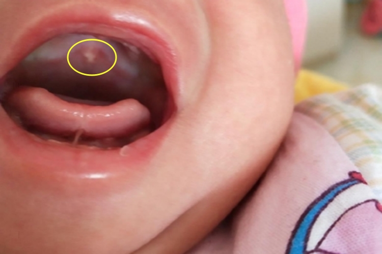 马牙口腔上腭有小白点图