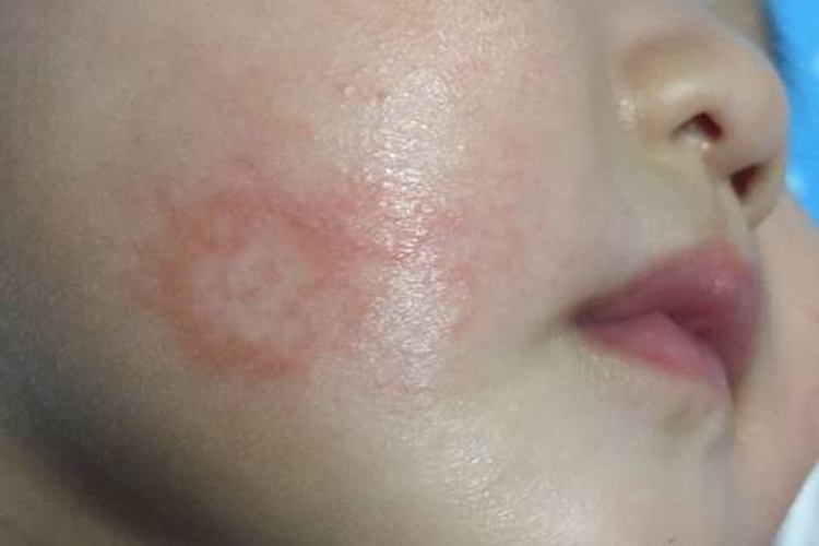 体癣小孩脸上长红斑块图
