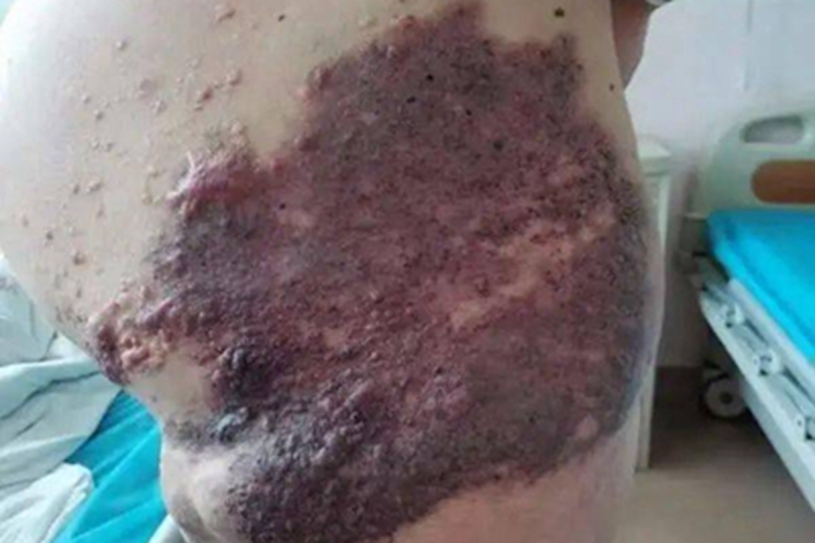 上皮样血管瘤大腿症状图