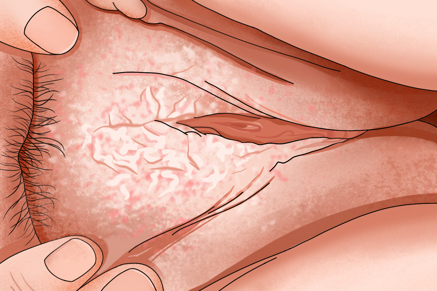 外阴黏膜白斑皮肤颜色变浅手绘图 外阴黏膜白斑皮肤颜色变浅手绘图
