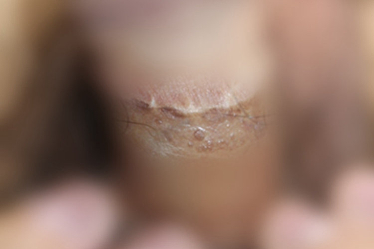 男性生殖器疱疹小疙瘩图 男性生殖器疱疹小疙瘩图