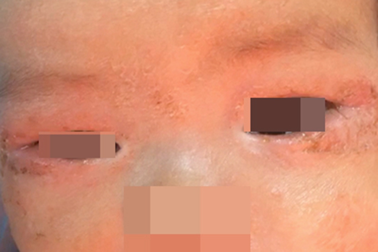 病毒性睑皮炎面部结痂图 病毒性睑皮炎面部结痂图