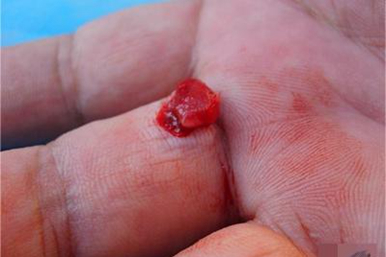 汞肉芽肿手指红色结节图